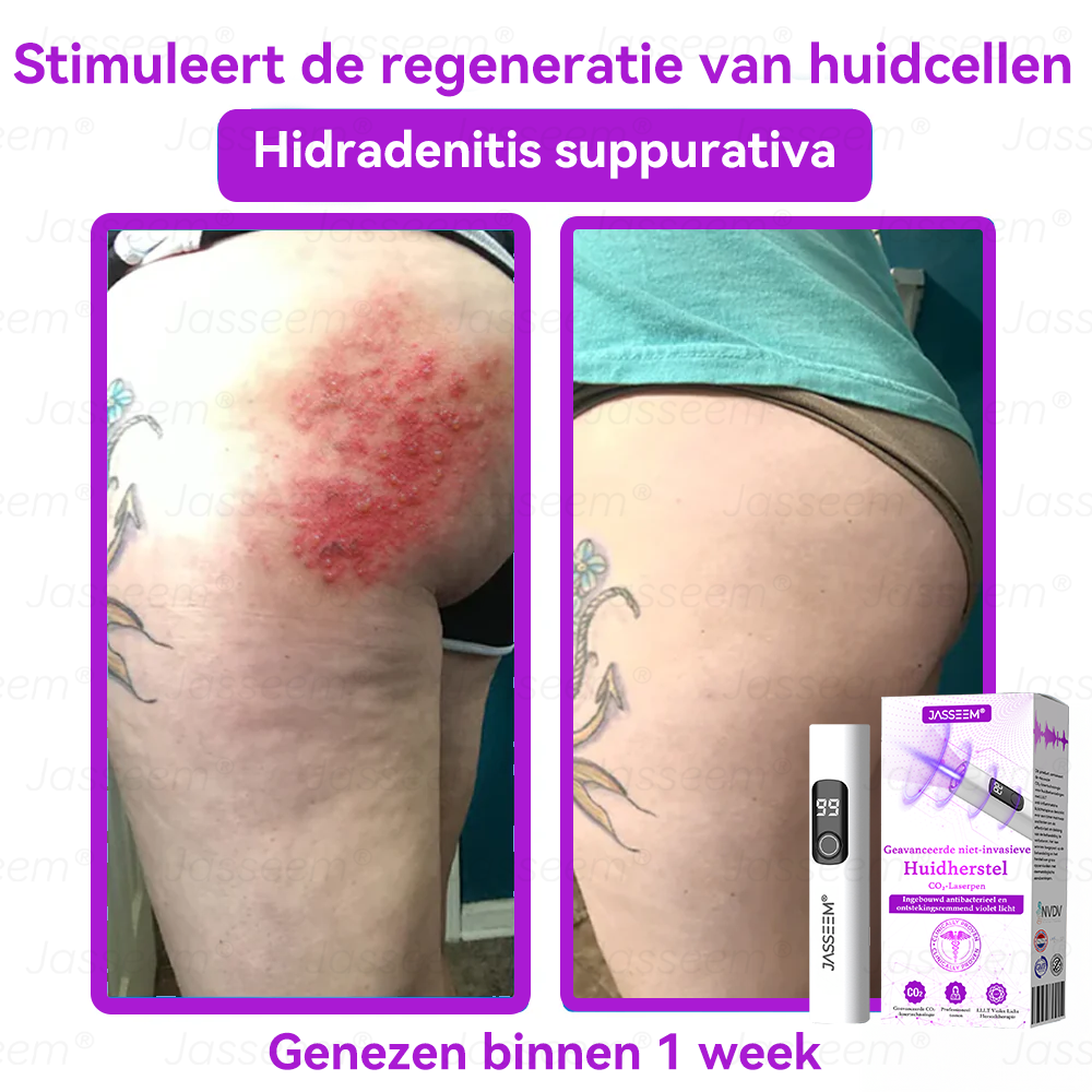 Vordela- Geavanceerde Niet-Invasieve Huidherstel CO₂-Laserpen