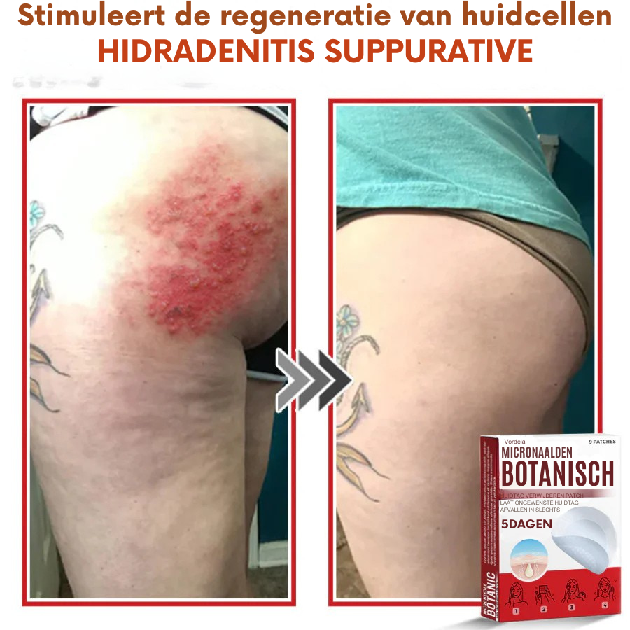Vordela® MicroNaald Botanisch Huidtag verwijderen patch
