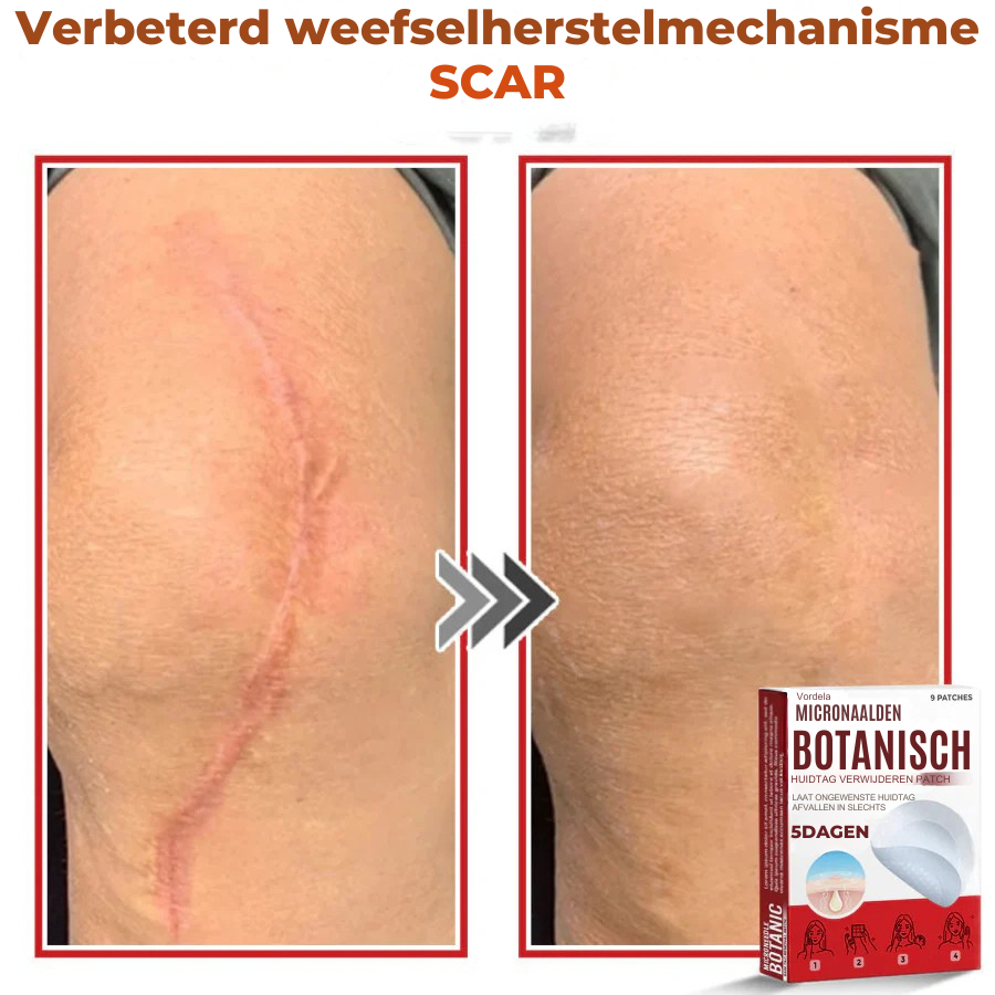 Vordela® MicroNaald Botanisch Huidtag verwijderen patch