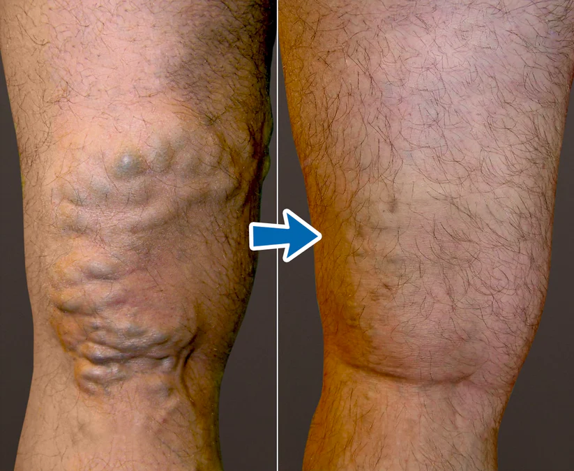 Vordela® VenoAid spataderspray