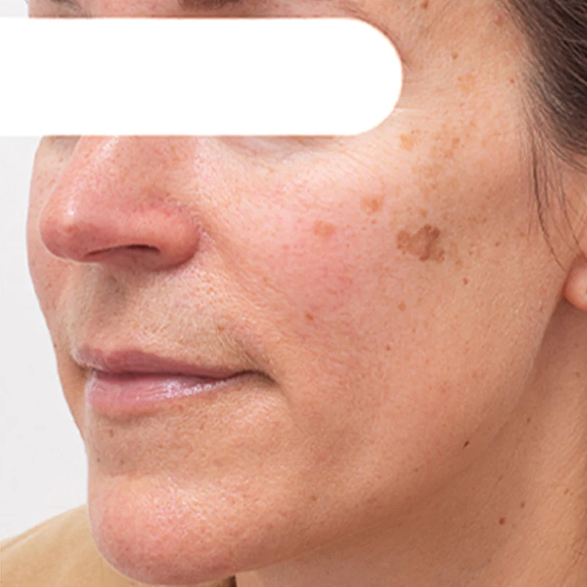 Vordela™ Kruidenvlekken Peel-Off Gezichtsmasker