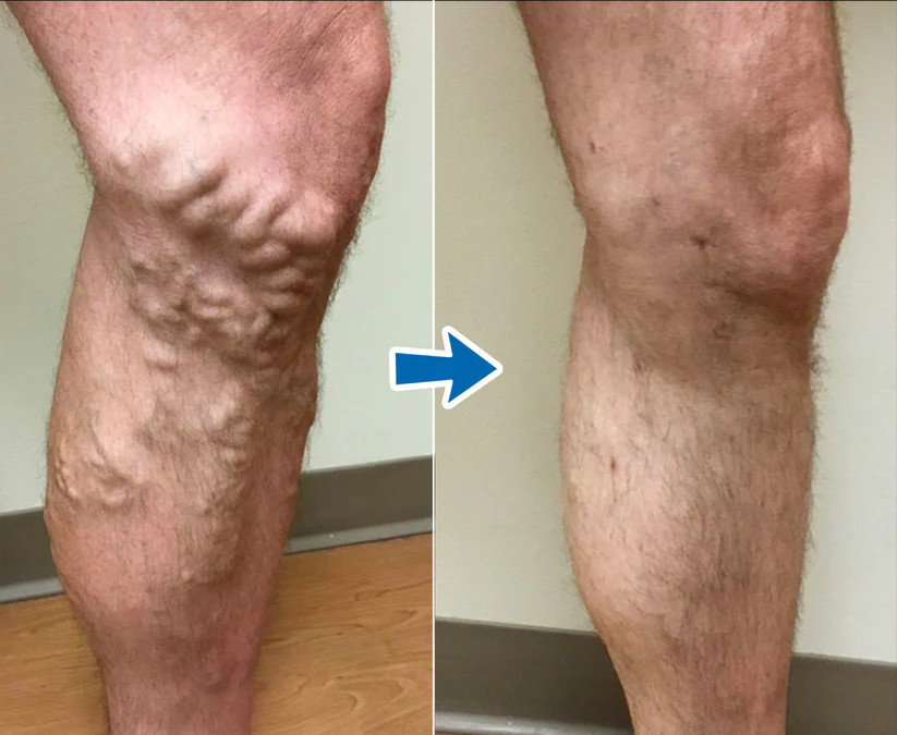 Vordela® VenoAid spataderspray