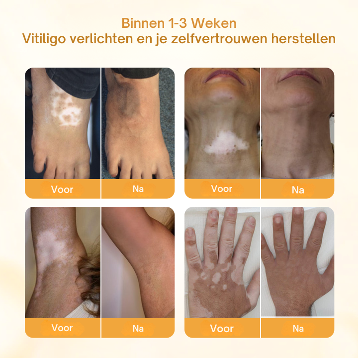 Vordela® VitiClear Pro Bijengif crème
