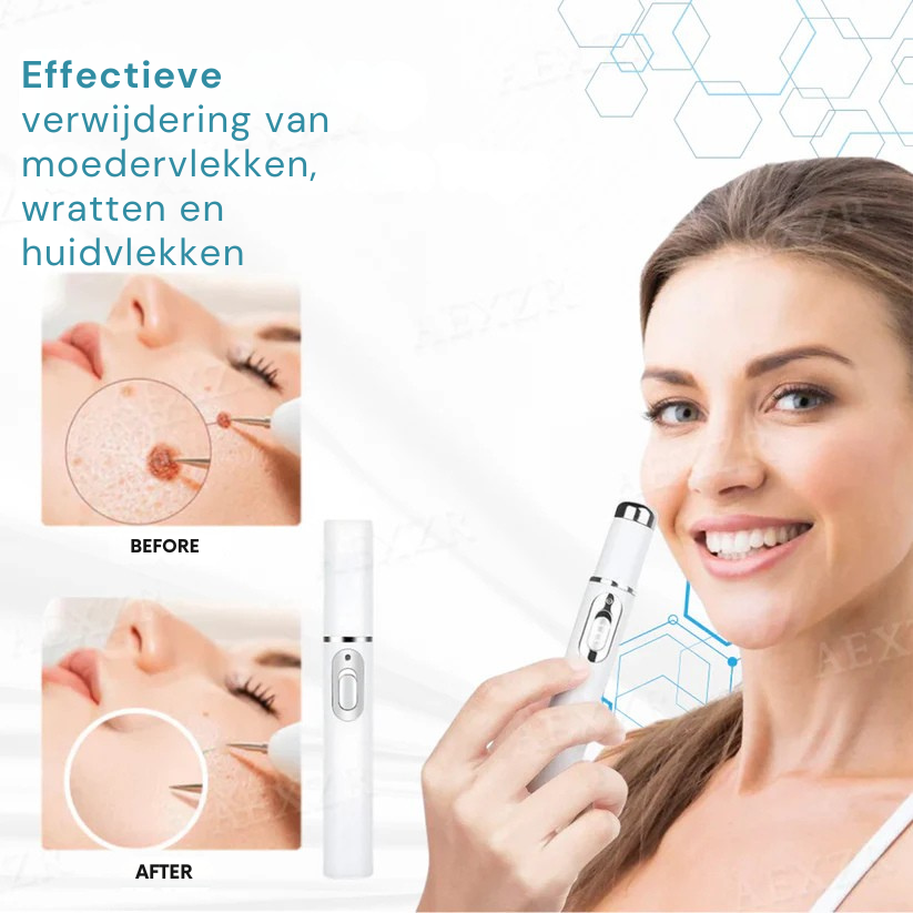 Vordela Niet-Invasieve Moedervlek- en Wratverwijderingslaserpen