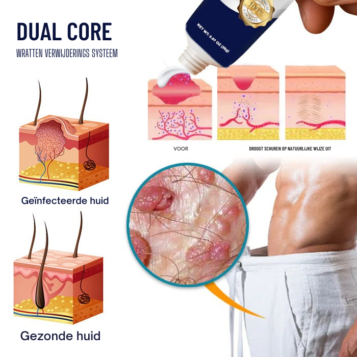 Vordela® Genitale Wratten Verwijder Crème 👨Ontworpen voor Mannen