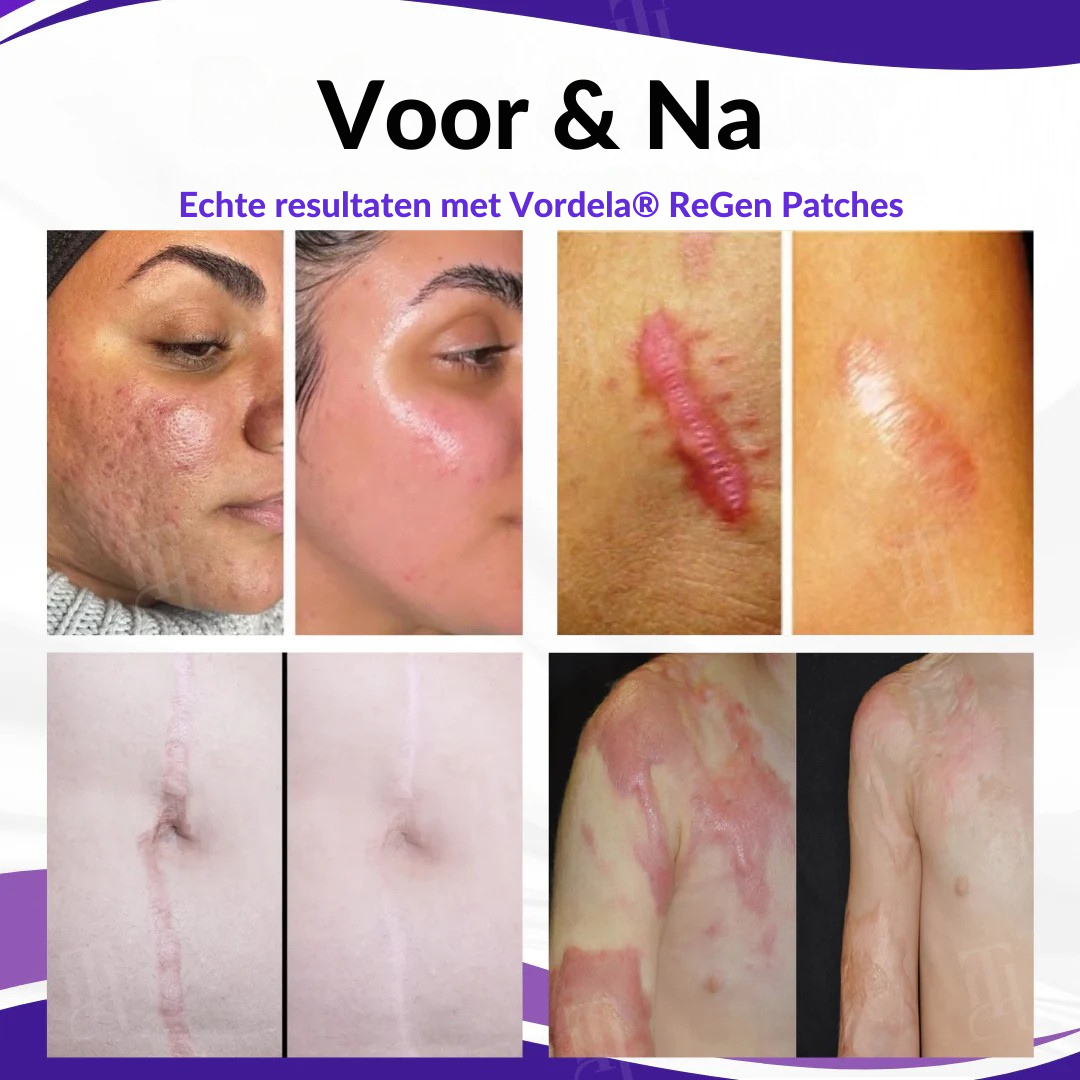 Vordela® ReGen Microneedles Pro Patches