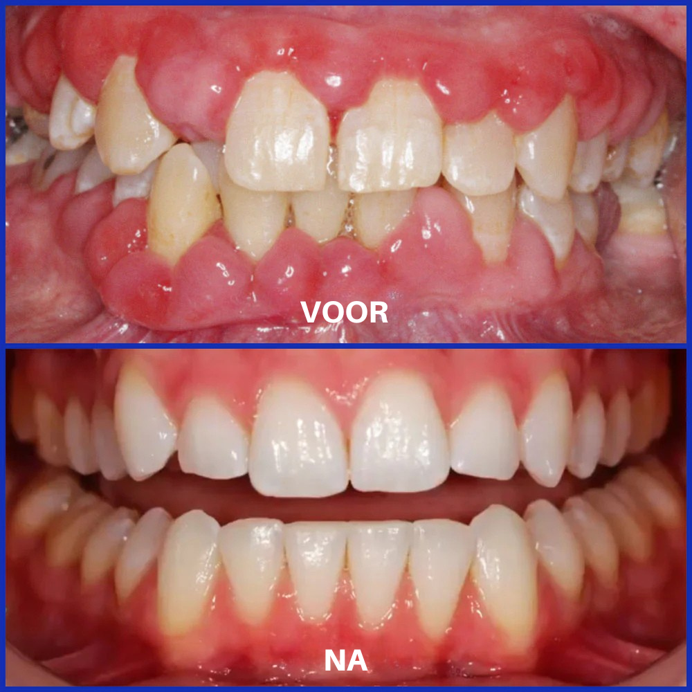 ❤️Vordela® Focussmile bijengif poeder voor oraal gebruik 🦷 (CE goedgekeurd)
