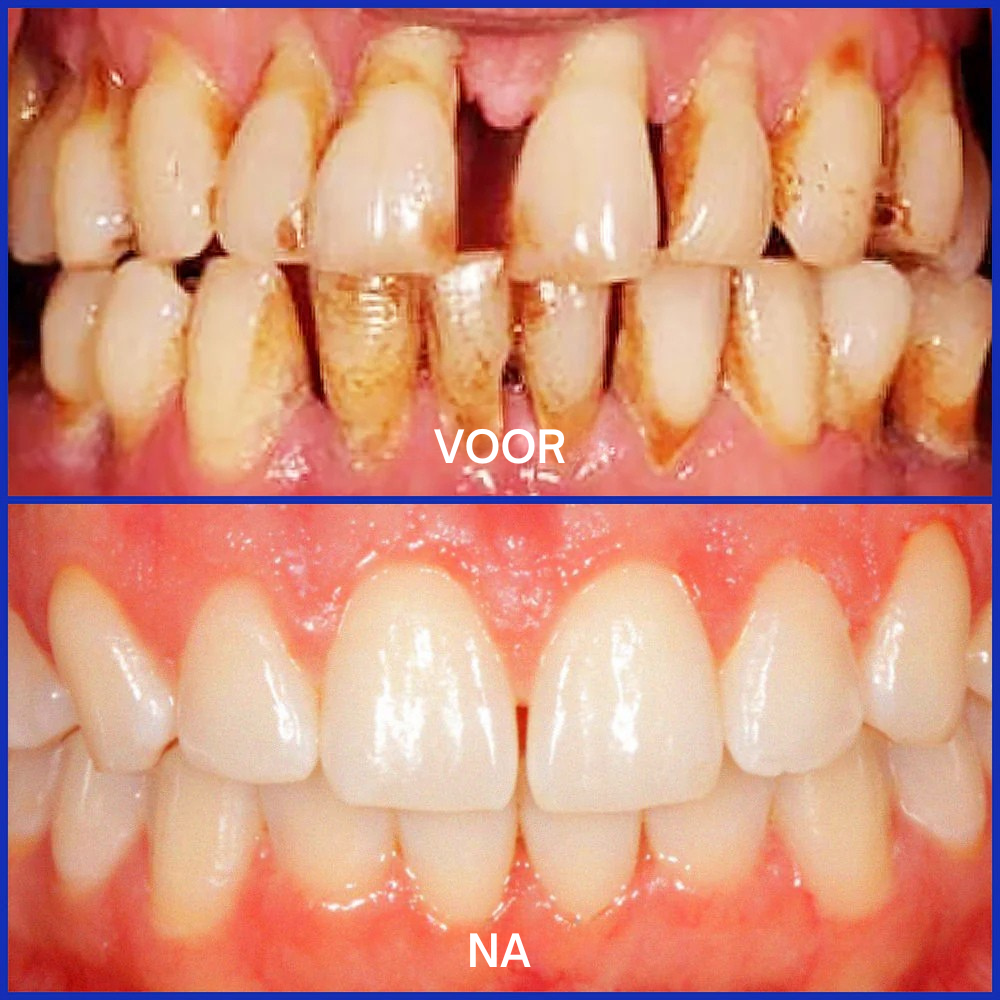 ❤️Vordela® Focussmile bijengif poeder voor oraal gebruik 🦷 (CE goedgekeurd)
