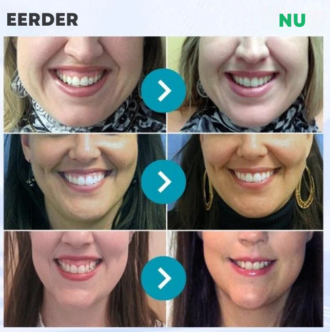 ❤️Vordela® Focussmile bijengif poeder voor oraal gebruik 🦷 (CE goedgekeurd)