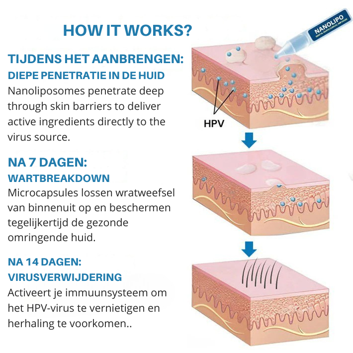 Vordela® NANOLIPO Genitale Wratten Klinische Ampullen