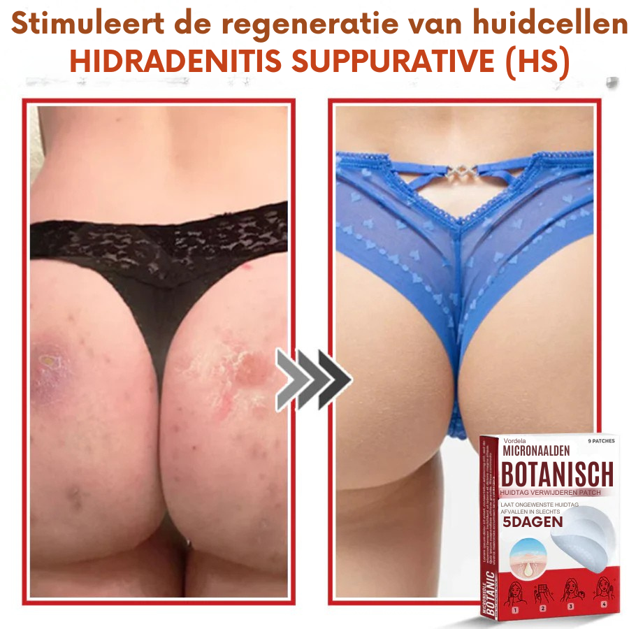 Vordela® MicroNaald Botanisch Huidtag verwijderen patch