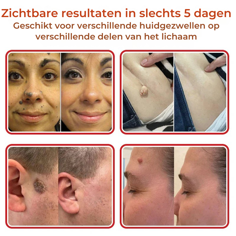 Vordela® MicroNaald Botanisch Huidtag verwijderen patch