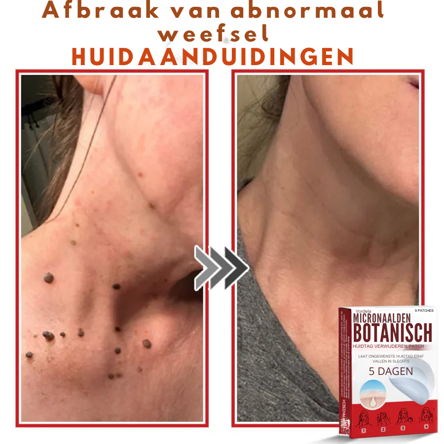 Vordela® MicroNaald Botanisch Huidtag verwijderen patch