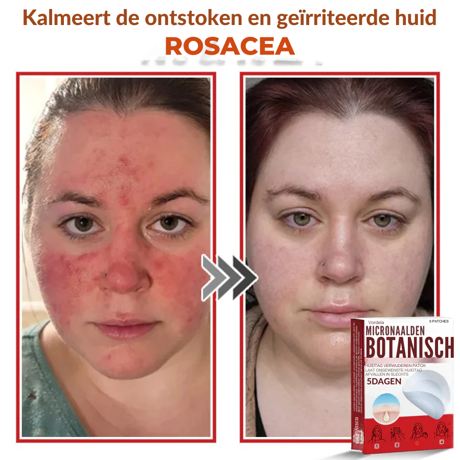 Vordela® MicroNaald Botanisch Huidtag verwijderen patch