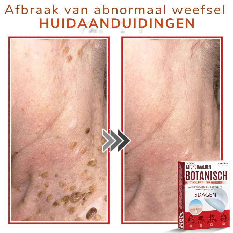 Vordela® MicroNaald Botanisch Huidtag verwijderen patch