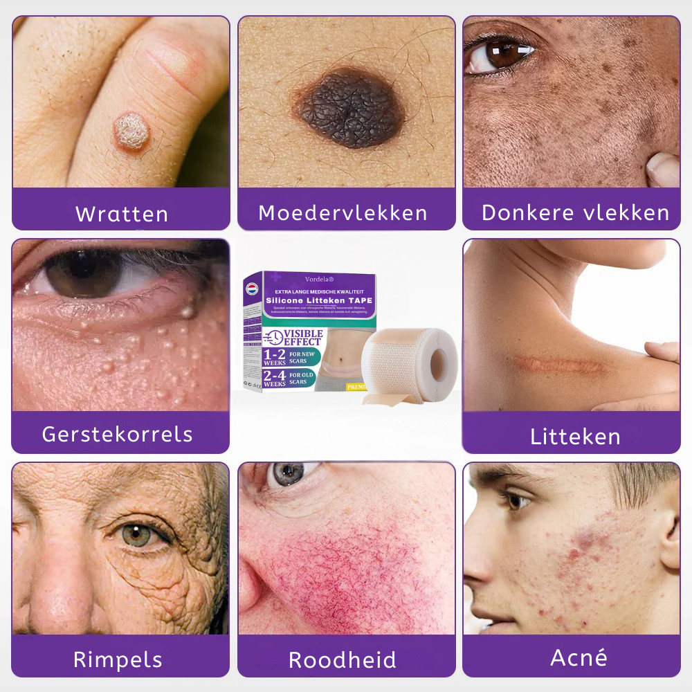 Vordela® 🏷️ ReGen Micronaald Tape met Nano-Hyaluronzuur 💊 Voor behandeling van littekens, striae, keloïden, acne, brandwonden en huidoneffenheden