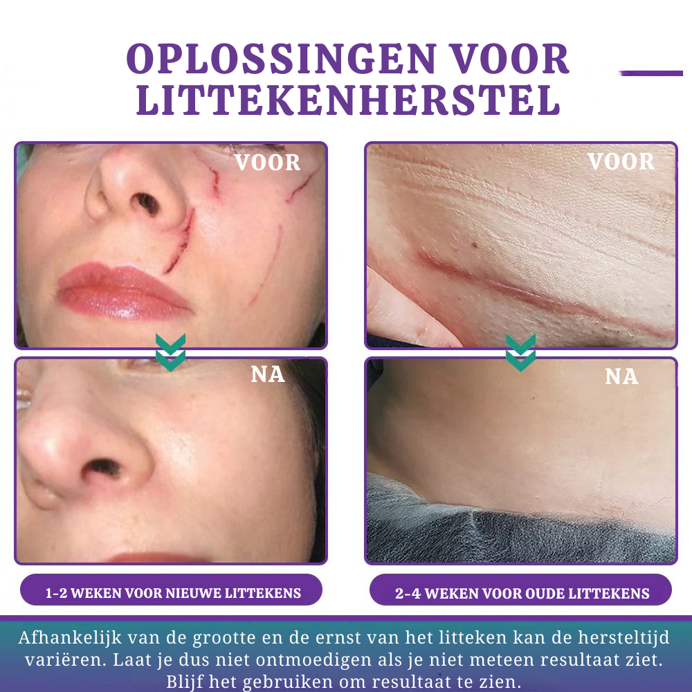 Vordela® 🏷️ ReGen Micronaald Tape met Nano-Hyaluronzuur 💊 Voor behandeling van littekens, striae, keloïden, acne, brandwonden en huidoneffenheden