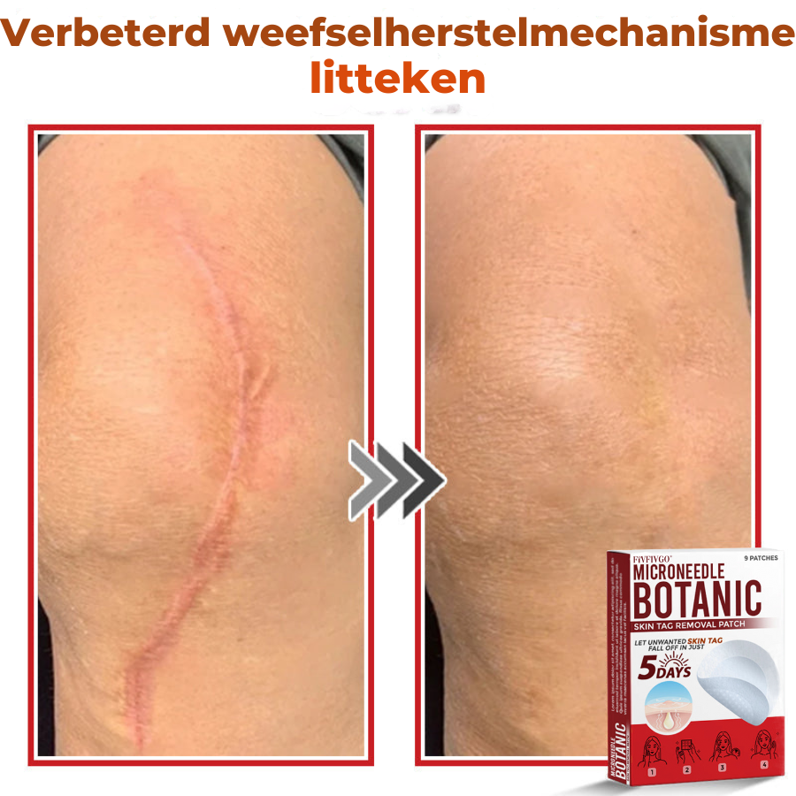 Vordela® MicroNeedle Botanic Skin Tag Removal Patch