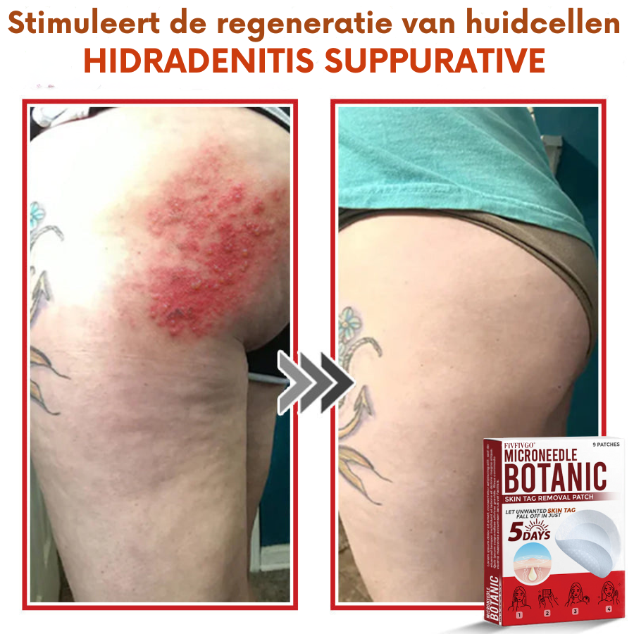 Vordela® MicroNeedle Botanic Skin Tag Removal Patch