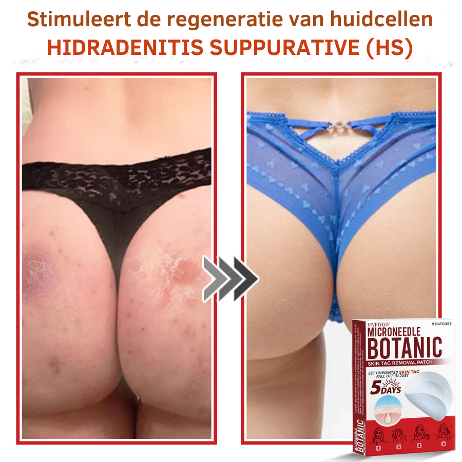 Vordela® MicroNeedle Botanic Skin Tag Removal Patch