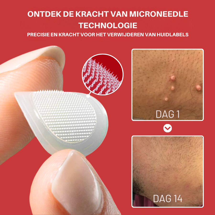 Vordela® MicroNeedle Botanic Skin Tag Removal Patch
