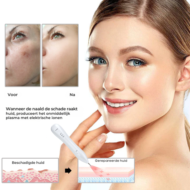 Vordela® Geavanceerde Plasma Laser Spot Schoonmaakpen