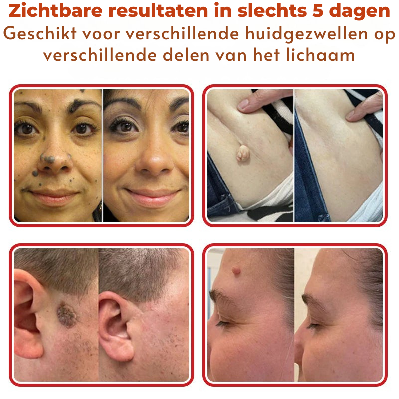 Vordela® MicroNeedle Botanic Skin Tag Removal Patch