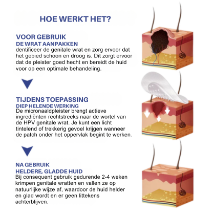 Vordela® Microneedle HPV Genitale Wratten Verwijderingspleister