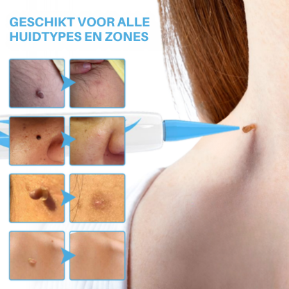 Vordela® pijnloze huidtagverwijderingspen voor thuisgebruik
