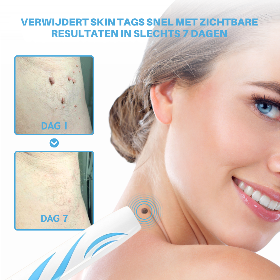 Vordela® pijnloze huidtagverwijderingspen voor thuisgebruik