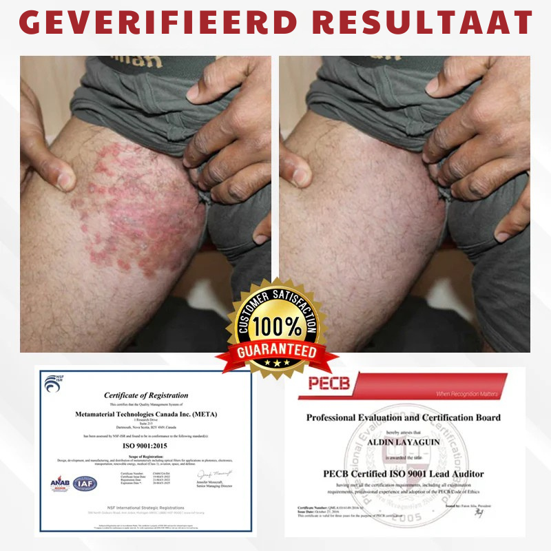 Vordela® HPV Wratten Verzorgingsspray voor mannen