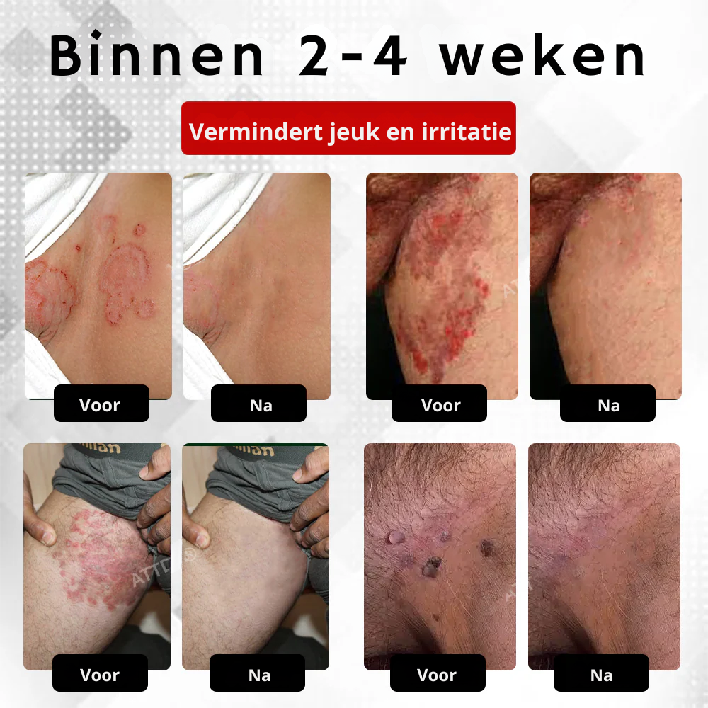 Vordela® HPV Wratten Verzorgingsspray voor mannen