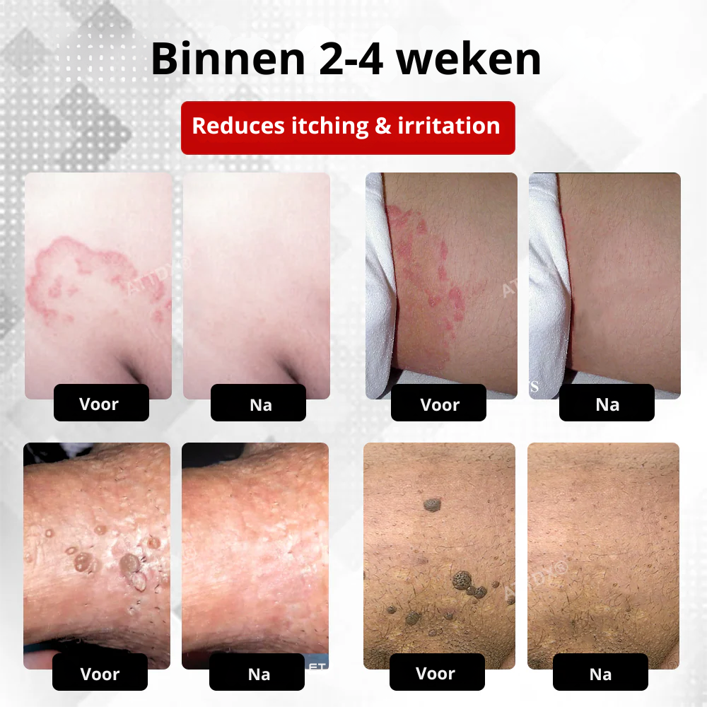 Vordela® HPV Wratten Verzorgingsspray voor mannen