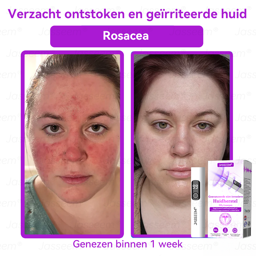 Vordela- Geavanceerde Niet-Invasieve Huidherstel CO₂-Laserpen