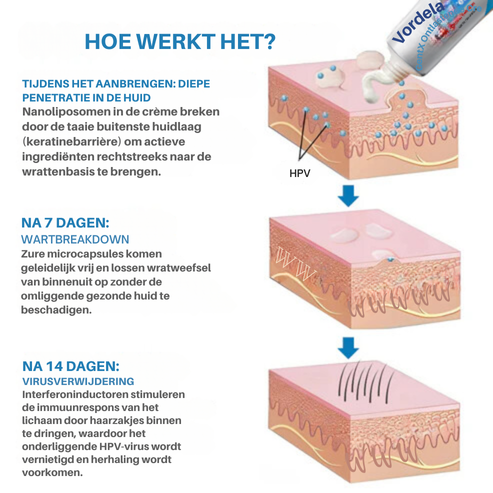 Vordela® HPV Genitale Wratten Verlichtingscrème