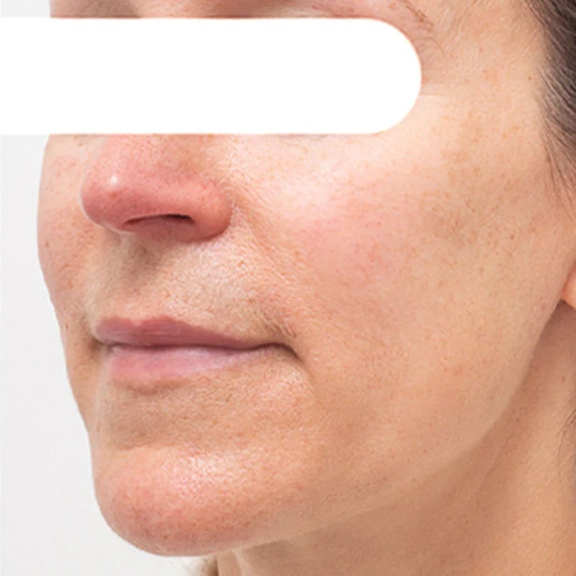 Vordela™ Kruidenvlekken Peel-Off Gezichtsmasker