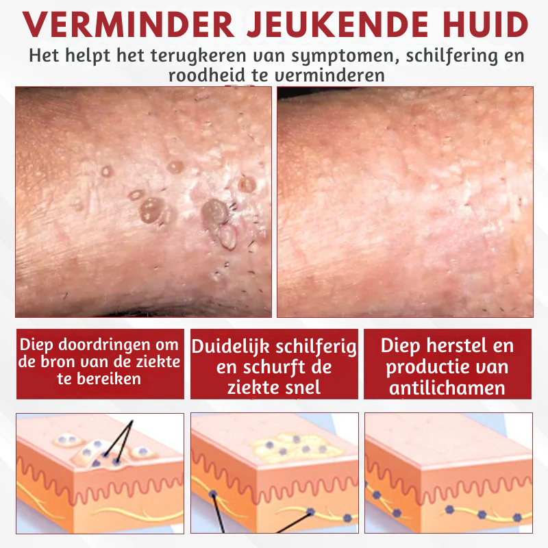 Vordela® HPV Wratten Verzorgingsspray voor mannen