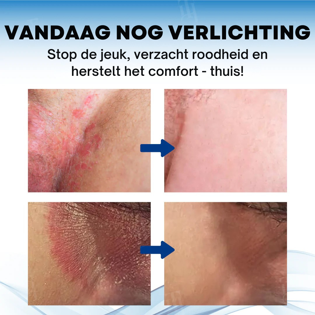 Vordela® Scrotum Itchy Treatment Cream
