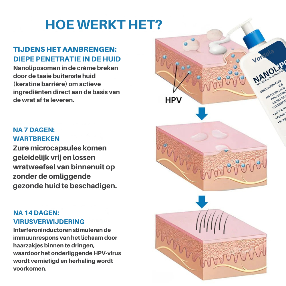 Vordela® NanoLipo HPV Genitale Wratten Waser Crème