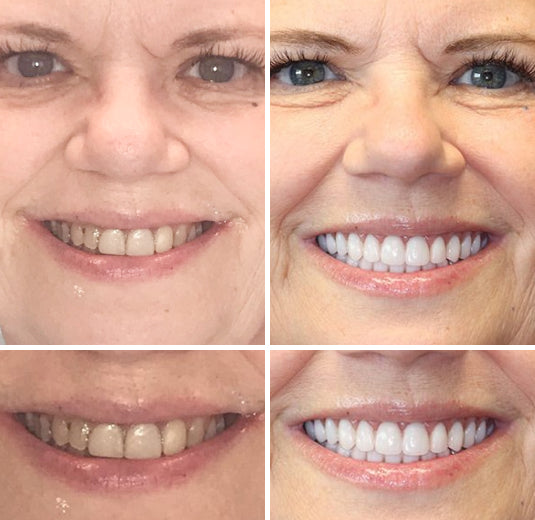 Vordela™ Premium Volledige Kunstgebit🦷Geavanceerde Aangepaste🦷 {CE-markering}