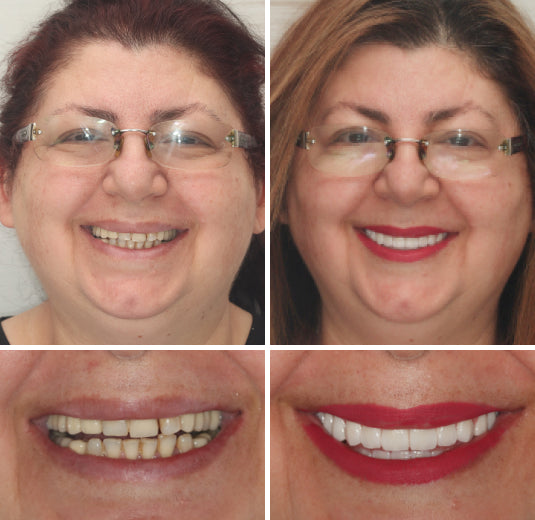 Vordela™ Premium Volledige Kunstgebit🦷Geavanceerde Aangepaste🦷 {CE-markering}