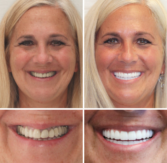 Vordela™ Premium Volledige Kunstgebit🦷Geavanceerde Aangepaste🦷 {CE-markering}