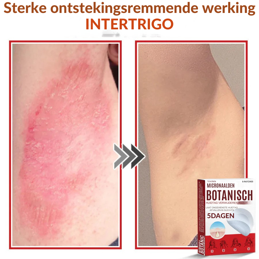 Vordela® MicroNaald Botanisch Huidtag verwijderen patch