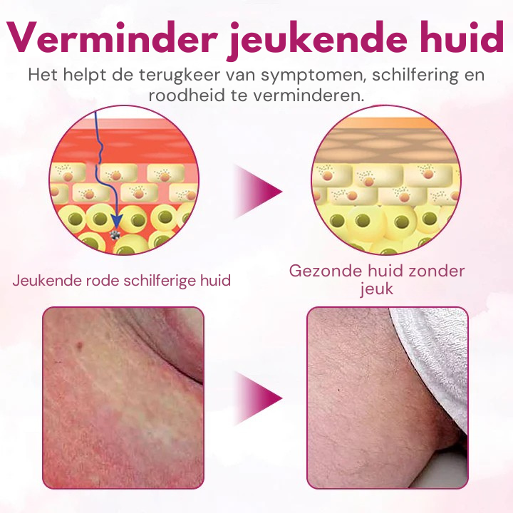 Vordela® HPV Verlichtingscrème PRO voor vrouwen