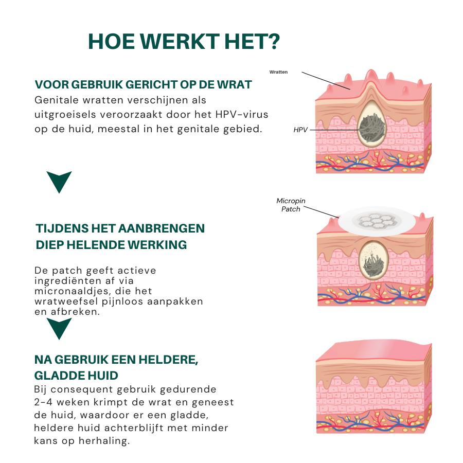 Vordela® Magnesium MicroPin HPV Genitale Wrat Verwijdering Patch