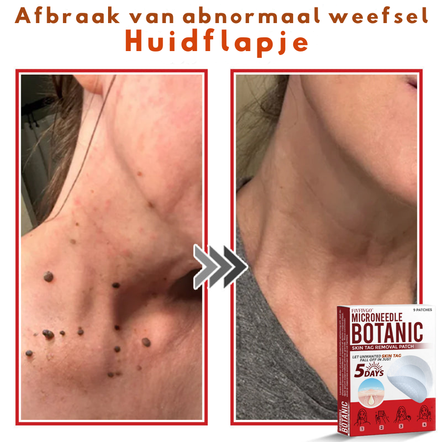 Vordela® MicroNeedle Botanic Skin Tag Removal Patch