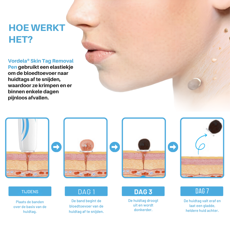 Vordela® pijnloze huidtagverwijderingspen voor thuisgebruik