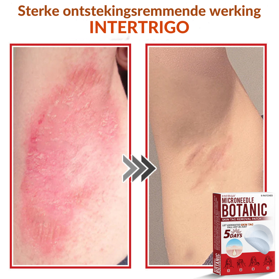 Vordela® MicroNeedle Botanic Skin Tag Removal Patch