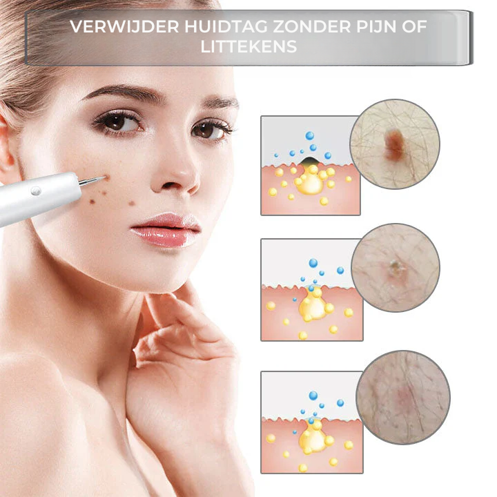 Vordela® Geavanceerde Plasma Laser Spot Schoonmaakpen