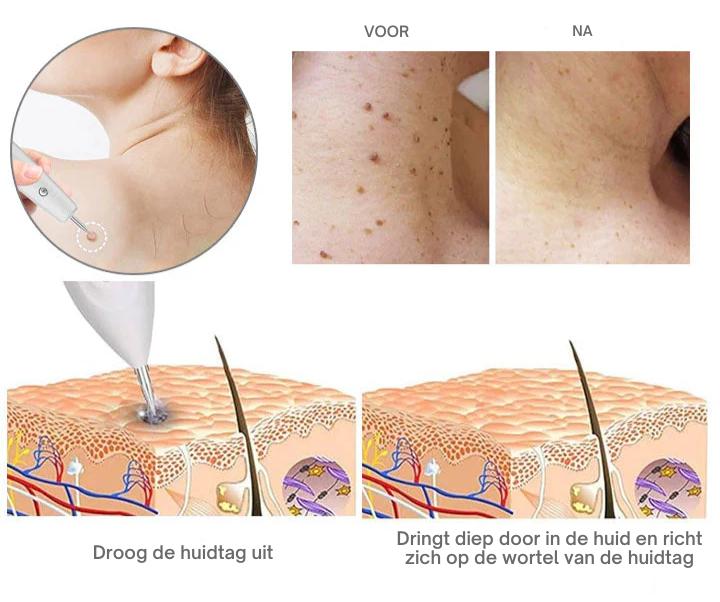 Vordela® Geavanceerde Plasma Laser Spot Schoonmaakpen